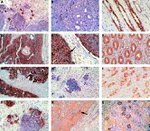 E-cadherin Antibody in Immunohistochemistry (IHC)