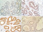 E-cadherin Antibody in Immunohistochemistry (IHC)
