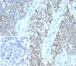 Wilm's Tumor 1 (WT1) (Wilm's Tumor and Mesothelial Marker) Monoclonal Antibody (WT1/7451)
