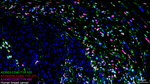 CD45 Antibody in Multiplex Immunohistochemistry (mIHC)