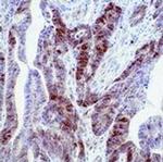 Thymidylate Synthase Antibody in Immunohistochemistry (IHC)