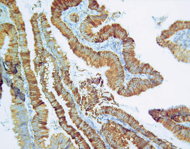 Thymidylate Synthase Antibody in Immunohistochemistry (IHC)