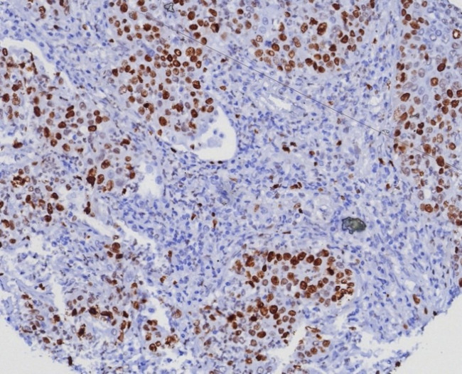 Ki-67 (Proliferating Cell Marker) Antibody in Immunohistochemistry (Paraffin) (IHC (P))