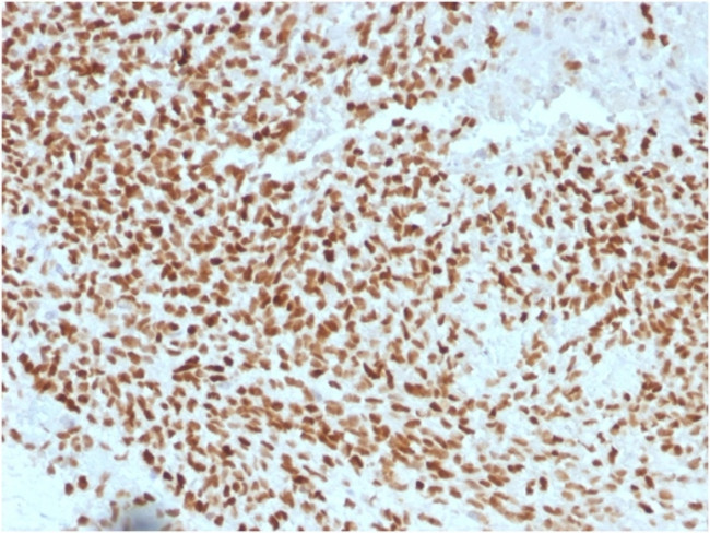 NKX2.2 (Neuroendocrine and Ewing's Sarcoma Marker) Antibody in Immunohistochemistry (Paraffin) (IHC (P))