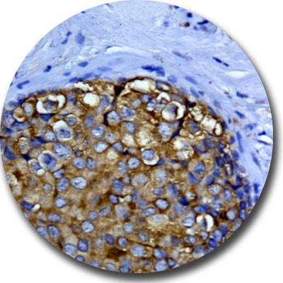 c-erbB-2/HER-2 Antibody in Immunohistochemistry (Paraffin) (IHC (P))