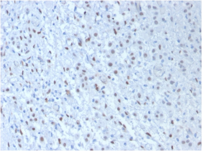 Wilm's Tumor 1 (WT1) (Wilm's Tumor and Mesothelial Marker) Antibody in Immunohistochemistry (Paraffin) (IHC (P))