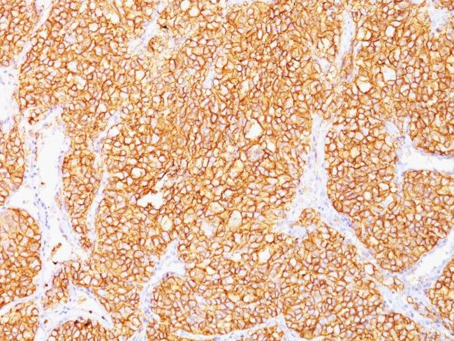 Renal Cell Carcinoma/gp200 (Carbonic Anhydrase IX) Antibody in Immunohistochemistry (Paraffin) (IHC (P))
