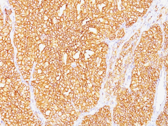 Renal Cell Carcinoma/gp200 (Carbonic Anhydrase IX) Antibody in Immunohistochemistry (Paraffin) (IHC (P))