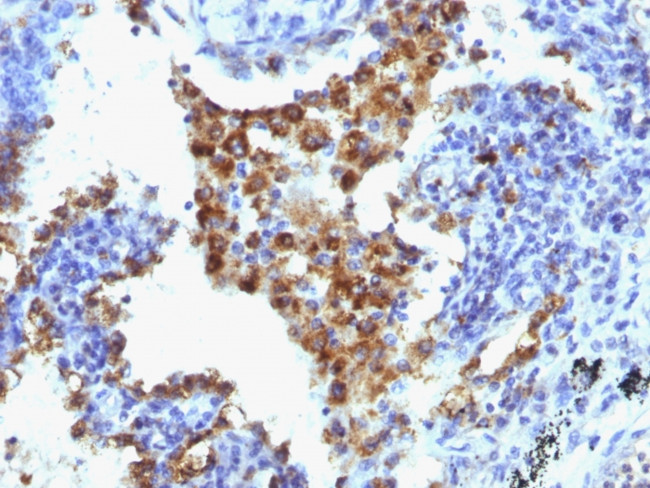 Napsin A (Lung Adenocarcinoma Marker) Antibody in Immunohistochemistry (Paraffin) (IHC (P))