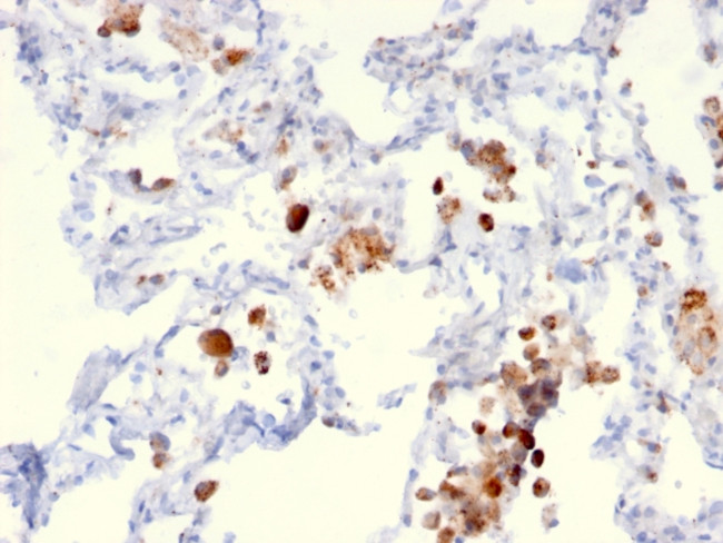 Napsin A (Lung Adenocarcinoma Marker) Antibody in Immunohistochemistry (Paraffin) (IHC (P))