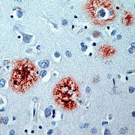 beta Amyloid Antibody in Immunohistochemistry (IHC)
