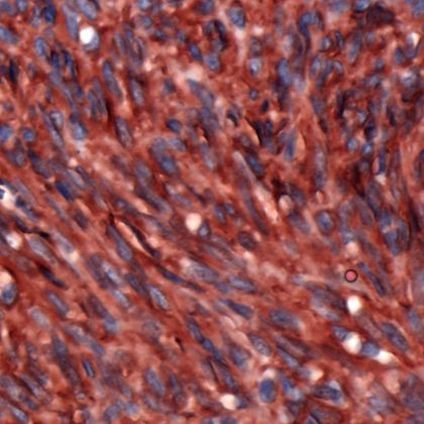 DOG-1 Antibody in Immunohistochemistry (IHC)