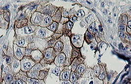 ERBB2 Antibody in Immunohistochemistry (Paraffin) (IHC (P))