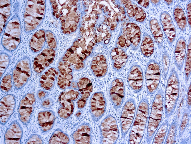 Colorectal Carcinoma Antibody in Immunohistochemistry (Paraffin) (IHC (P))