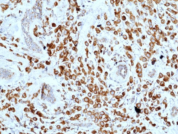 CD227 (Mucin 1) Antibody in Immunohistochemistry (Paraffin) (IHC (P))