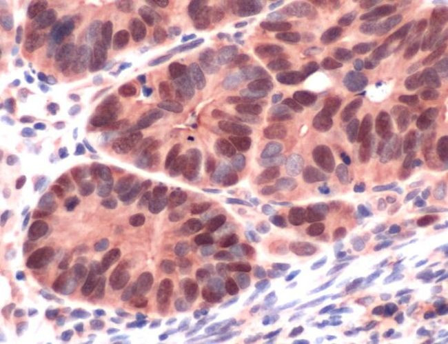 MSH6 Antibody in Immunohistochemistry (IHC)