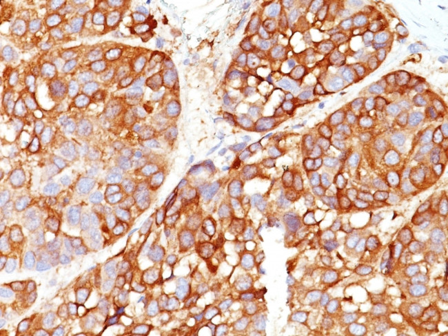 Melanoma Marker (MART-1 + Tyrosinase + gp100) Antibody in Immunohistochemistry (Paraffin) (IHC (P))