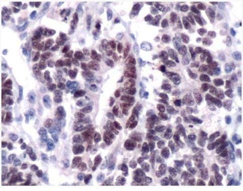 WT1 Antibody in Immunohistochemistry (IHC)