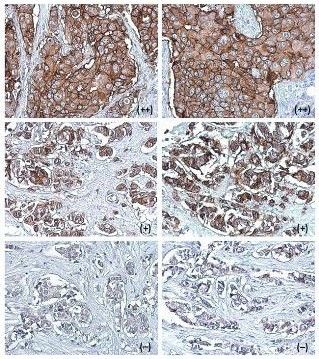ErbB2 (HER-2) Antibody in Immunohistochemistry (Paraffin) (IHC (P))