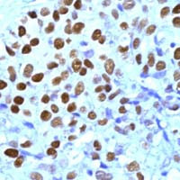 Progesterone Receptor Antibody in Immunohistochemistry (IHC)