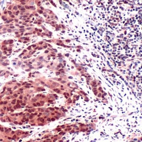 Thymidylate Synthase Antibody in Immunohistochemistry (IHC)