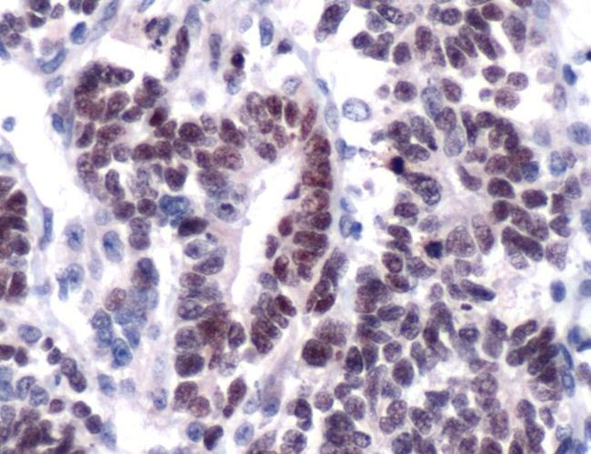 WT1 Antibody in Immunohistochemistry (IHC)