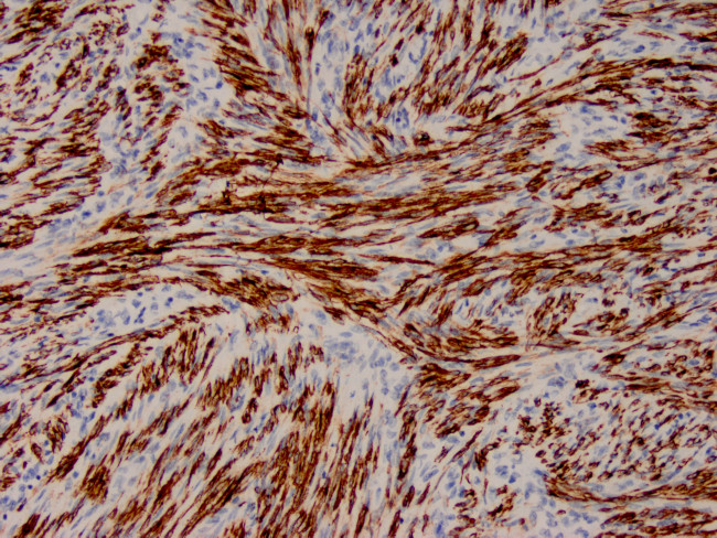 Actin, Smooth Muscle Antibody in Immunohistochemistry (Paraffin) (IHC (P))