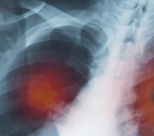 A novel strategy for whole lung analysis with micro-optical sectioning tomography