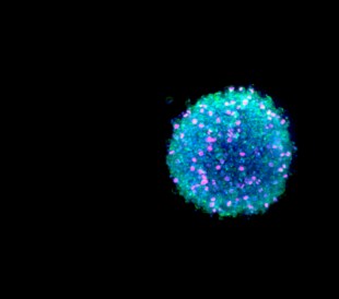 Cancer Organoid