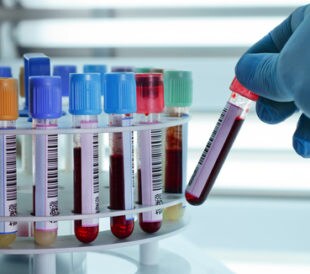 Test tubes of blood being placed in a centrifuge. Image: angellodeco/Shutterstock.com