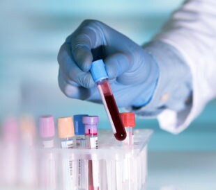 Hands of a lab technician with a tube of blood sample and a rack with other samples/lab technician holding blood tube sample for study. Image: angellodeco/Shutterstock.com.
