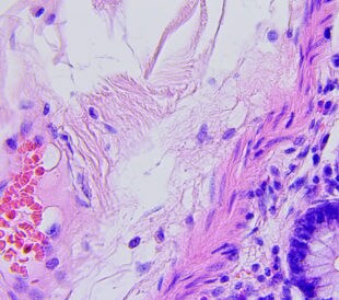 Colon cancer microscopic photograph. Image: dzika_mrowka/Shutterstock.com.