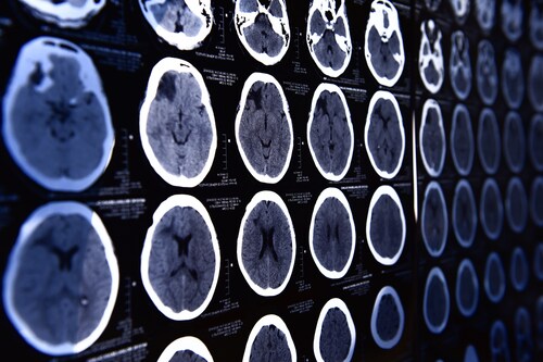 Images from a computerized tomography of the brain. Image: nimon/Shutterstock.com.