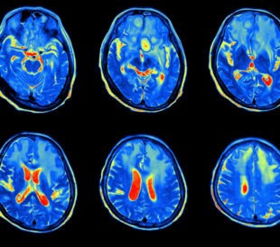 MRI scan image of brain. Image: AkeSak/Shutterstock.com.