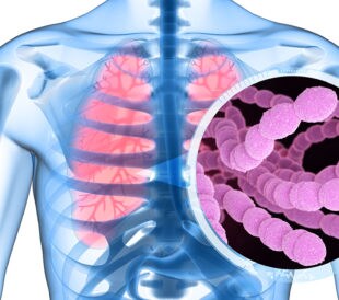 Streptococcus pneumoniae or pneumococcus