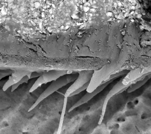 Biomineralization of composite filling in human tooth