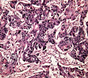 liver cancer cells