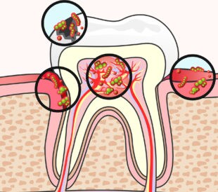 Endodontic Disease