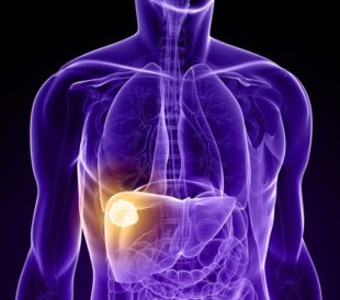 Hepatocellular carcinoma