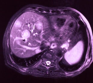 Hepatocellular carcinoma