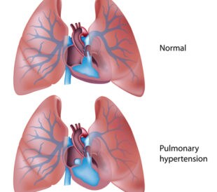 pulmonary hypertension
