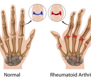 Rheumatoid Arthritis