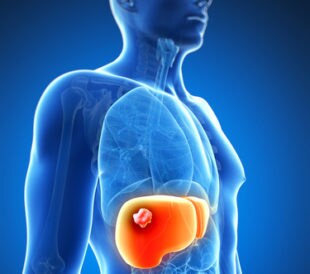 liver cancer