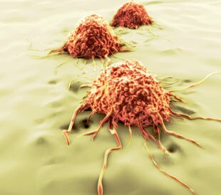 tumor cells metastasis