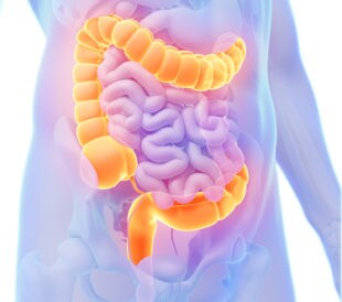 colon cancer