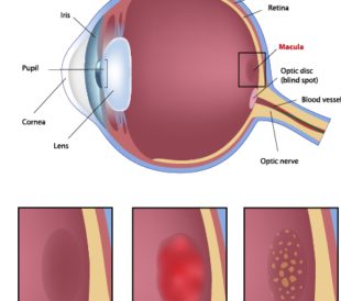 macular degeneration