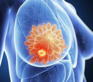 breast cancer