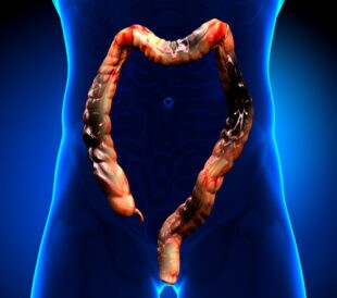 Colorectal cancer. Image: decade3d - anatomy online/Shutterstock.com