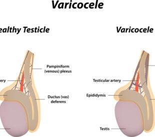 Varicocele. Image: joshya/Shutterstock.com