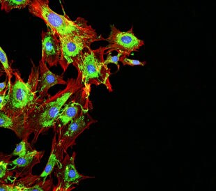 Metastatic cancer cells. Image: DrimaFilm/Shutterstock.com